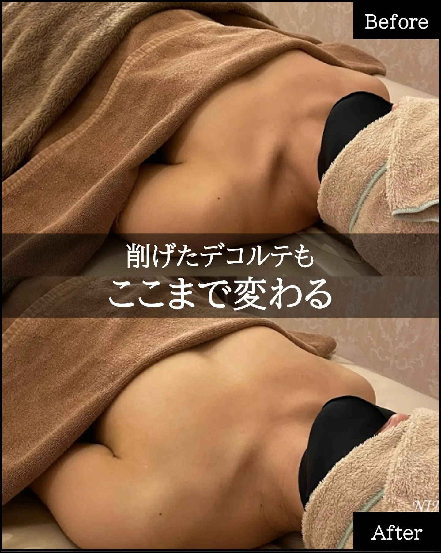 バストが大きくならない理由は脂肪がないからではありません